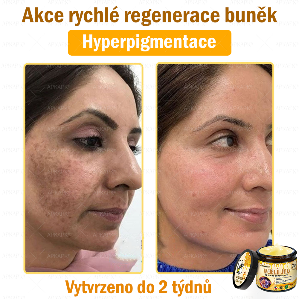 Dermatologicky a klinicky testováno👩‍⚕️APKAPK®Bee Venom Krém na obnovení pleti🐝 pomáhá při léčbě kožních problémů, jako jsou: vrásky, jizvy, pigmentové skvrny, strie, akné, psoriáza, ekzém, kožní změny, podráždění, záněty a další kožní problémy.